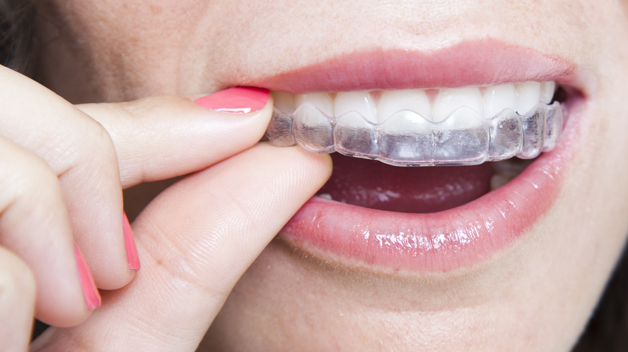 Clear Aligners