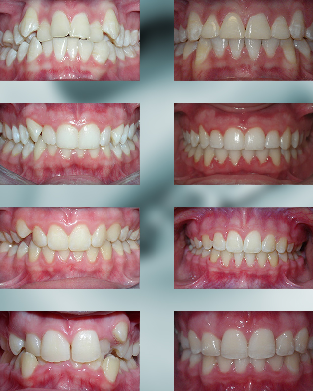 Crowding Teeth